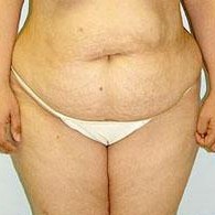 Post Natal Baby Belly