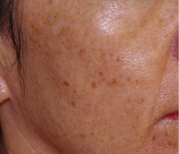Skin spots - RightDiagnosis.com